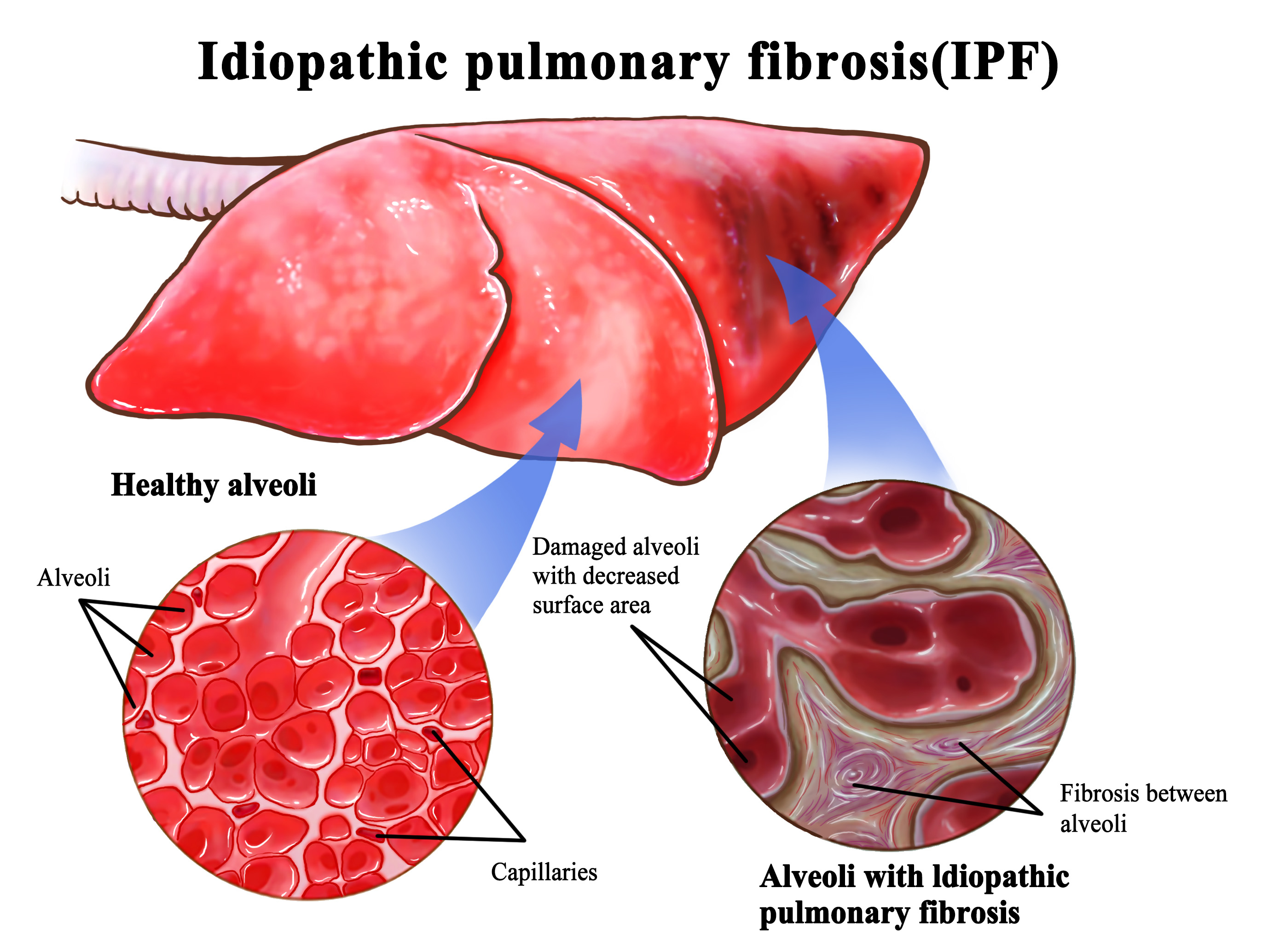 Idiopathic Pulmonary Fibrosis (IPF)